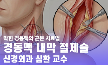 막힌 경동맥의 근본 치료법, ‘경동맥 내막 절제술’ - [인천 뇌혈관질환 명의] 가톨릭관동대학교 국제성모병원 신경외과 심환석 교수
